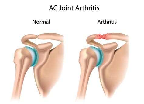 Acromioclavicular Ac Joint Osteoarthritis Orthoutah Orthopaedic | My ...