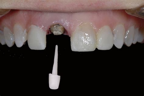 White Post & Core for Dental Crown - Advanced Cosmetic Dentistry