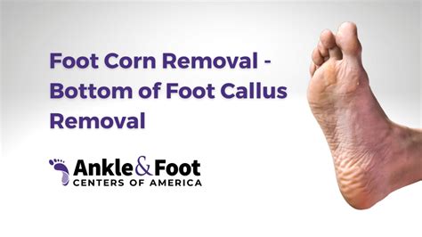 Corn Removal & What You Need to Know | Ankle & Foot Centers