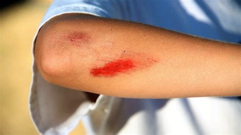 Wound Care: 5 Natural Ways To Heal Cuts And Scrapes. - YouTube