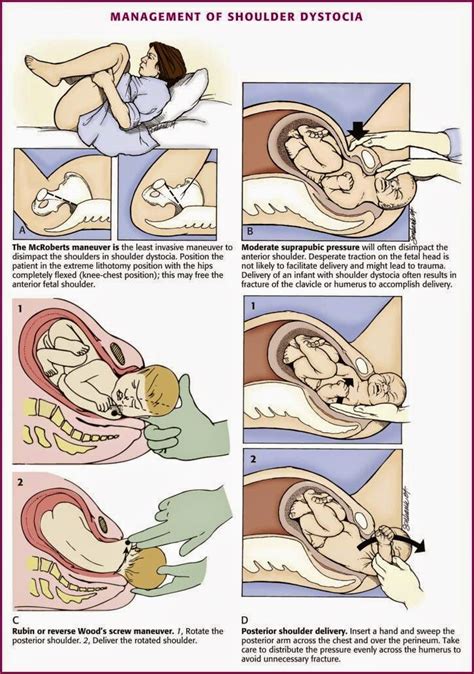 Shoulder Dystocia Management