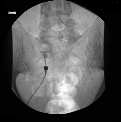 S1 nerve root injection (fluoroscopy) | Image | Radiopaedia.org