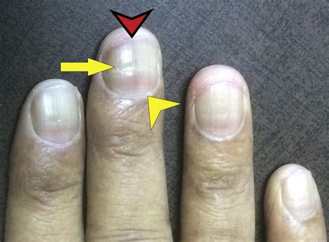 Nail Changes in Cirrhosis and Reversal After Adult & Pediatric Liver Transplantation - Journal ...