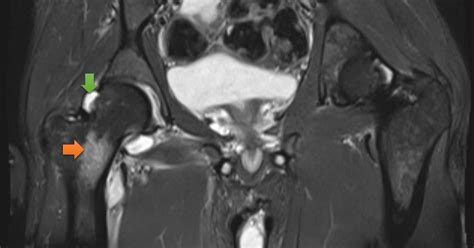 Ultimate Radiology : Septic arthritis of hip joint