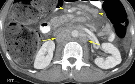 Ct Scan Abdomen Pelvisretroperitoneal Lymph Nodes Not Enlarged | The ...