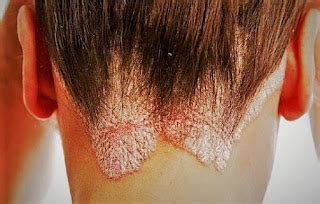 WISH UR HEALTH: PSORIASIS : Symptoms; Diagnosis; Types; Causes; Treatment; Home Remidies