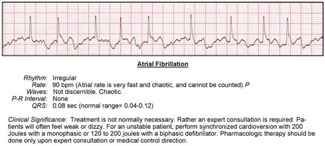 Atrial Fibrillation ECG - ACLS Wiki