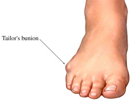 What is That Bump On the Outside of My Foot? Are You Suffering From a Tailor's Bunion ...