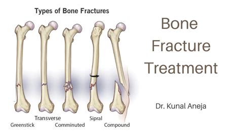 Bone Fracture Treatment - Dr. Kunal Aneja