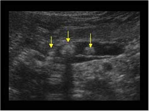 Abdomen and retroperitoneum | 1.3 Pancreas : Case 1.3.7 Pancreas calcifications | Ultrasound Cases