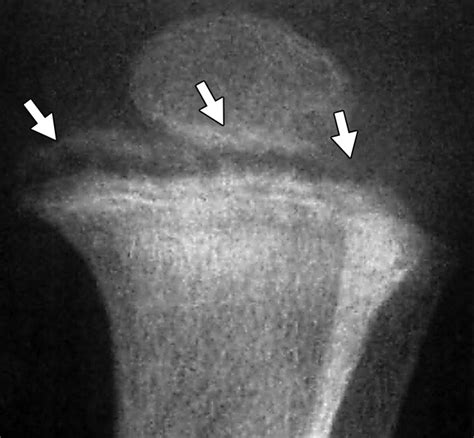 A Critical Review of the Classic Metaphyseal Lesion: Traumatic or Metabolic? | AJR