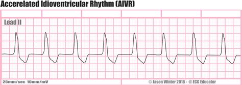 ECG Educator Blog : Ventricular Rhythms