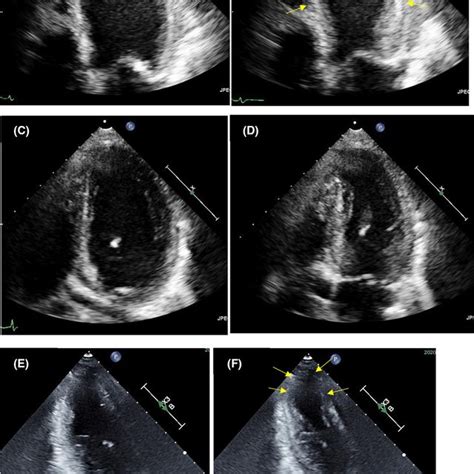 Echocardiography on acute heart failure due to TC (A: diastole and B:... | Download Scientific ...