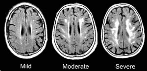 Cerebral Small Vessel Disease (CSVD): Symptoms and Treatment - Geriatric Academy