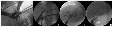 Therapeutic transjejunal endoscopy for the treatment of biliary ...