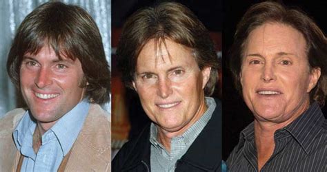 Bruce Jenner Plastic Surgery Before and After Pictures 2024