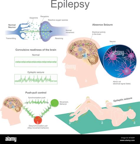 Epilepsy is a group of neurological disorders characterized by epileptic seizures. Epileptic ...