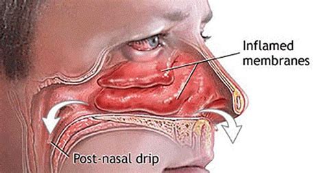 DIY: How To Clear Your Sinuses in Seconds Using Nothing but Your ...