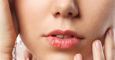 Itchy Small Red and White Bumps On Lips – Reasons & Treatment