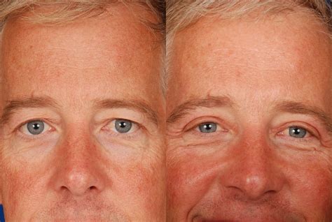 Photo Gallery: Blepharoplasty | Edmon P. Khoury MD