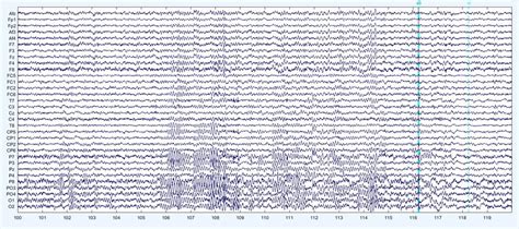 330 questions with answers in EEG SIGNAL PROCESSING | Science topic