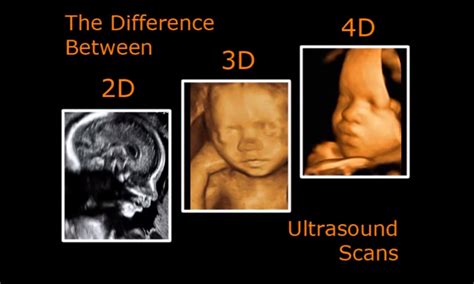 What Is The Difference Between 3d And 4d Ultrasound Over The Womb | Images and Photos finder