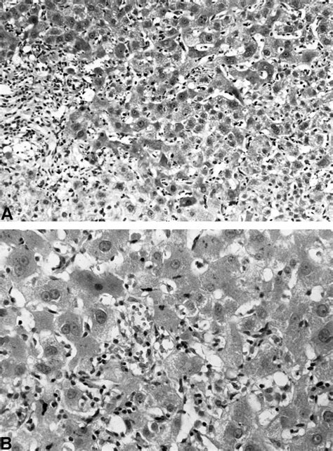 Liver histology of a patient with cholestatic hepatitis after intake of... | Download Scientific ...