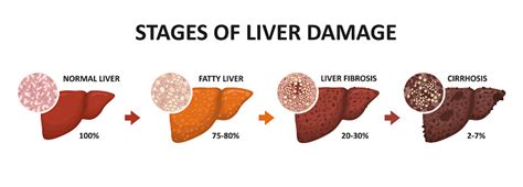 Stages Of Liver Damage Healthy Fatty Liver Fibrosis And Cirrhosis Stock Illustration - Download ...