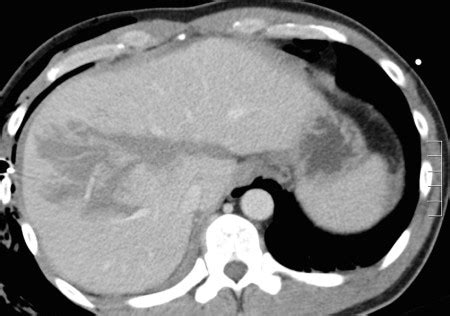 Liver laceration - Radiology at St. Vincent's University Hospital