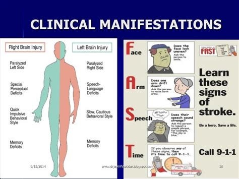 Cerebrovascular accident