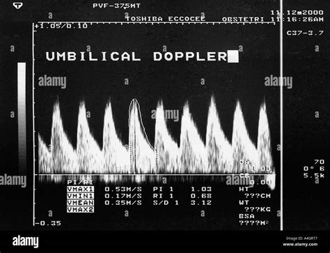 Ultrasound scan - normal umbilical artery Dopplers Stock Photo - Alamy