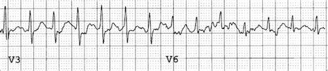 Real Psychiatry: Inappropriate Sinus Tachycardia (IST) In The ...