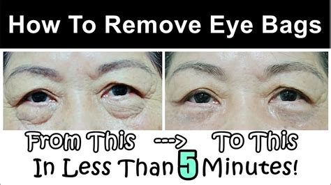 How To Get Rid of & Remove Eye Bags (Instantly Ageless Puffy Eye Bag Removal) - YouTube