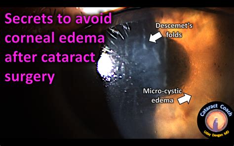 Secrets to Avoid Corneal Edema after Cataract Surgery – Cataract Coach