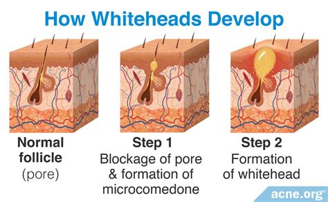 What Is a Whitehead? - Acne.org