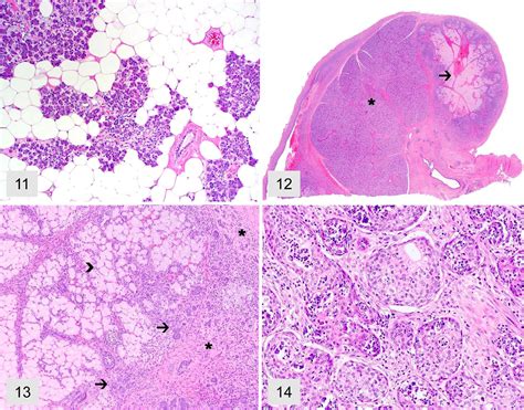 Necrotizing Sialometaplasia Histology