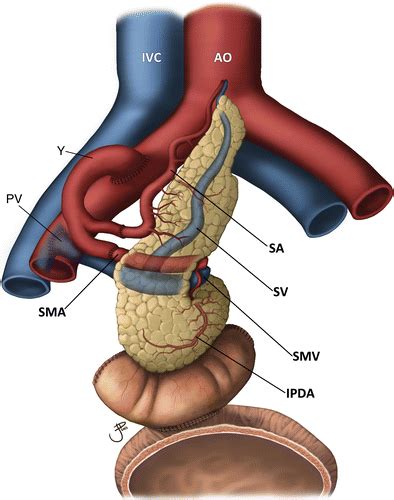 Pancreas Transplant Imaging: How I Do It | Radiology