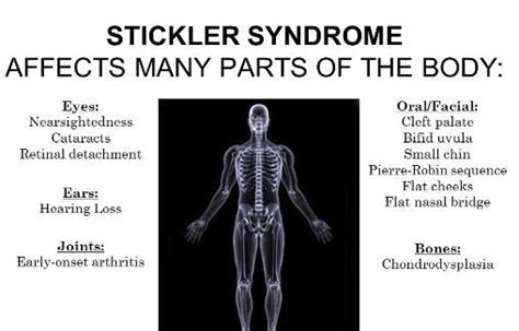 Stickler syndrome body organs | Ehlers danlos syndrome awareness ...