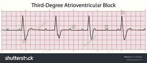 Third-degree AV Block (3rd Degree AV Block, AV Block 3, AV, 52% OFF