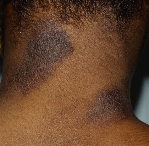 10 Most Common Skin Rashes On Black Skin | Hives On Black Skin