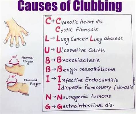 Causes of clubbing. - MEDizzy