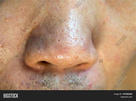 Close Acne Acne Holes Image & Photo (Free Trial) | Bigstock