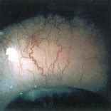 Photograph showing the conjunctival lesion at presentation. | Download ...