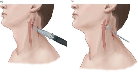 Penetrating Neck Injuries – Core EM