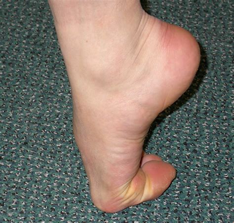 Hallux Rigidus (Big Toe Arthritis) - The Foot and Ankle Clinic