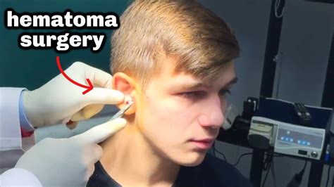 Cauliflower Ear Surgery