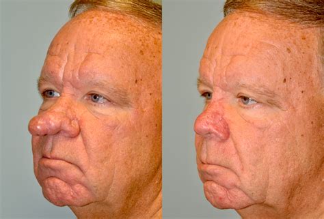 what is rhinophyma - pictures, photos