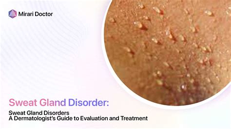 Sweat Gland Disorders: A Dermatologist’s Guide to Evaluation and Treatment