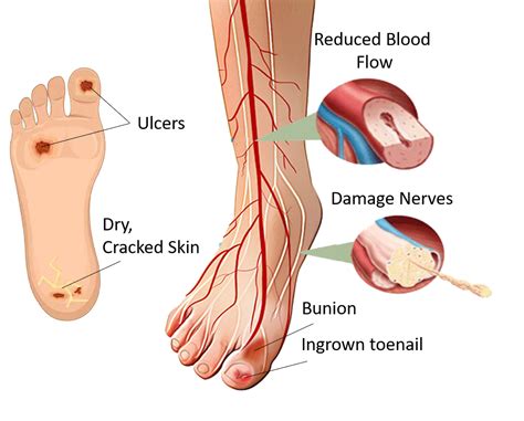 Diabetic Foot Ulcer