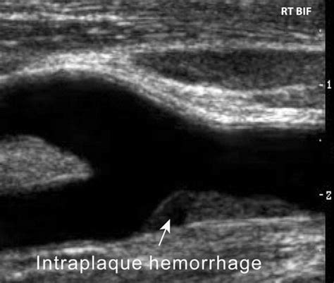 Sonographic Examination of the Carotid Arteries | RadioGraphics | Medical ultrasound, Medical ...